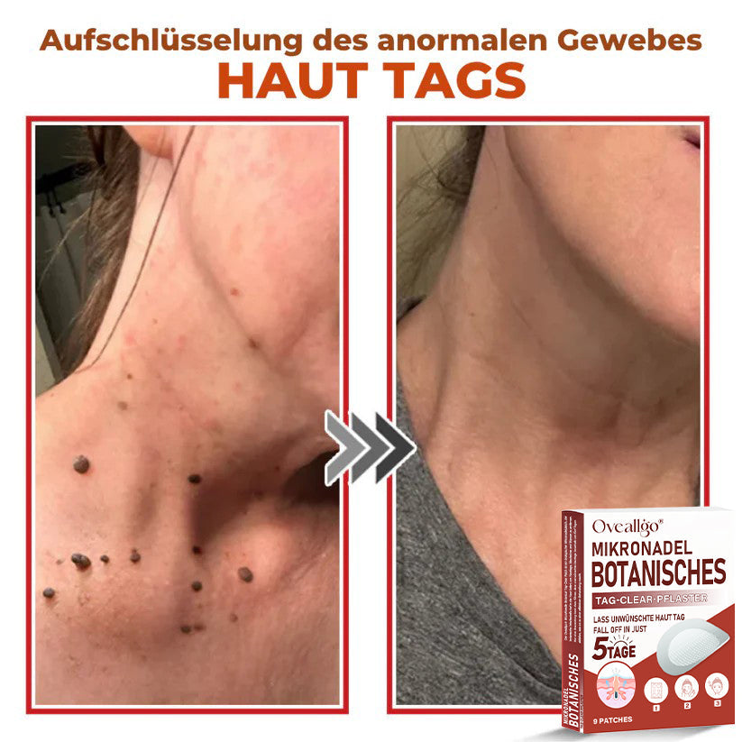 Oveallgo® MikroNadel Botanisches Tag-Clear-Pflaster Pro 🇩🇪 Hergestellt in der Germany