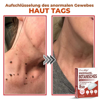 Oveallgo® MikroNadel Botanisches Tag-Clear-Pflaster Pro 🇩🇪 Hergestellt in der Germany