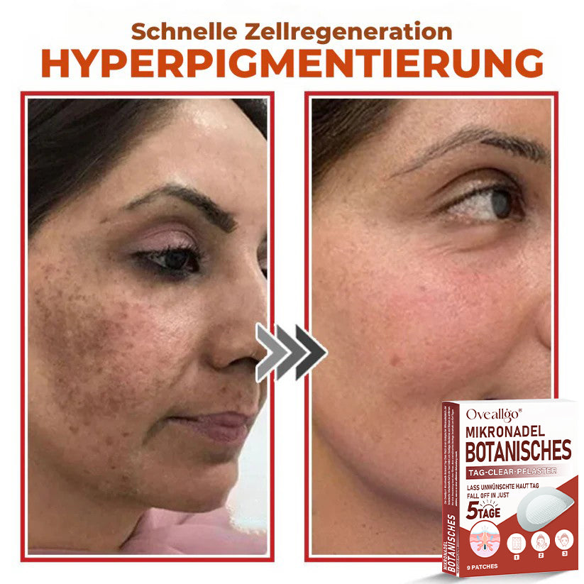 Oveallgo® MikroNadel Botanisches Tag-Clear-Pflaster Pro 🇩🇪 Hergestellt in der Germany