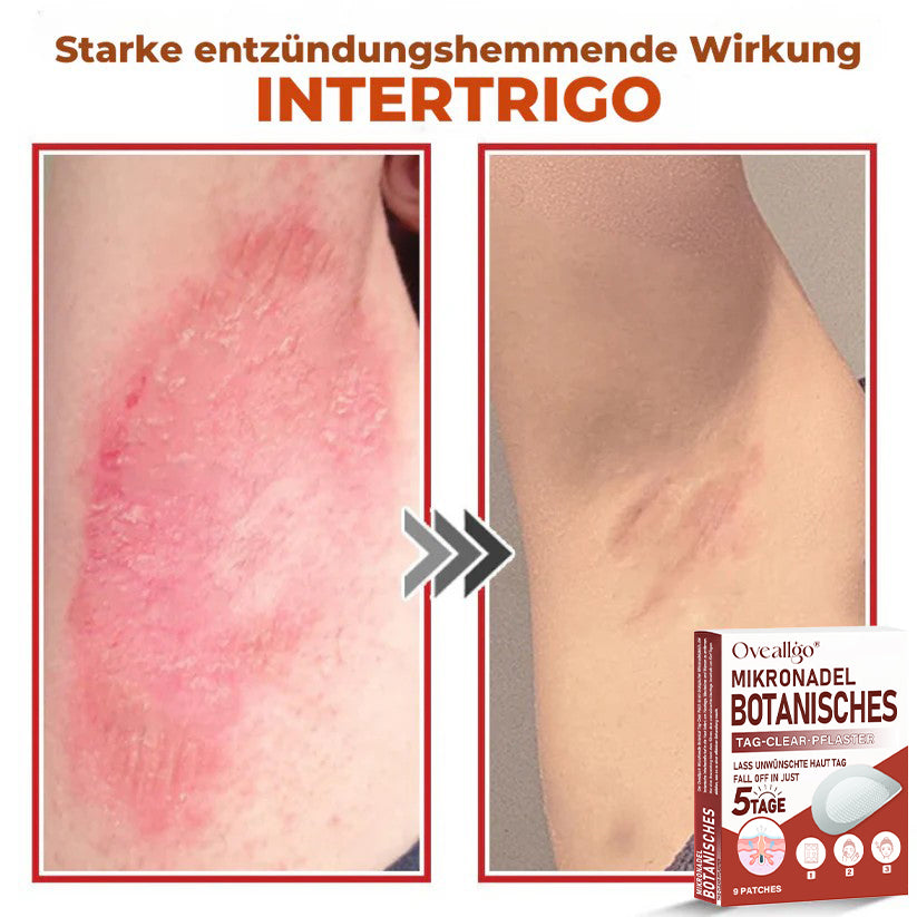 Oveallgo® MikroNadel Botanisches Tag-Clear-Pflaster Pro 🇩🇪 Hergestellt in der Germany