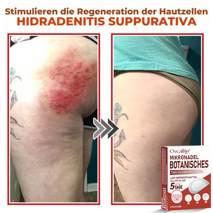 Oveallgo® MikroNadel Botanisches Tag-Clear-Pflaster Pro 🇩🇪 Hergestellt in der Germany