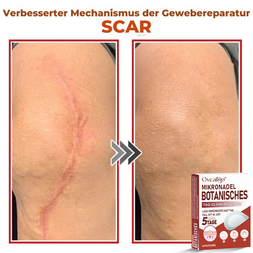 Oveallgo® MikroNadel Botanisches Tag-Clear-Pflaster Pro 🇩🇪 Hergestellt in der Germany