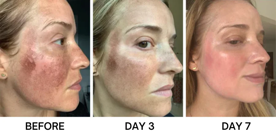 Bikenda® Portable Skin Care Laser Pen