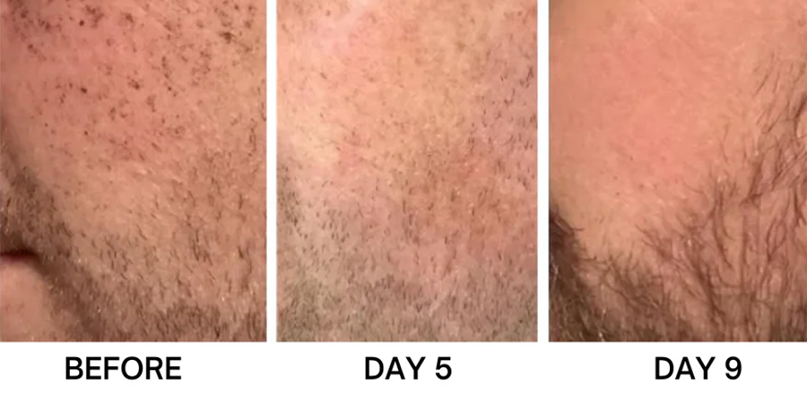 Bikenda® Portable Skin Care Laser Pen