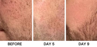 Bikenda® Portable Skin Care Laser Pen