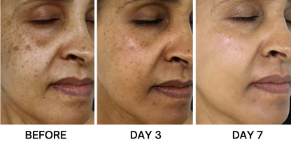 Bikenda® Portable Skin Care Laser Pen