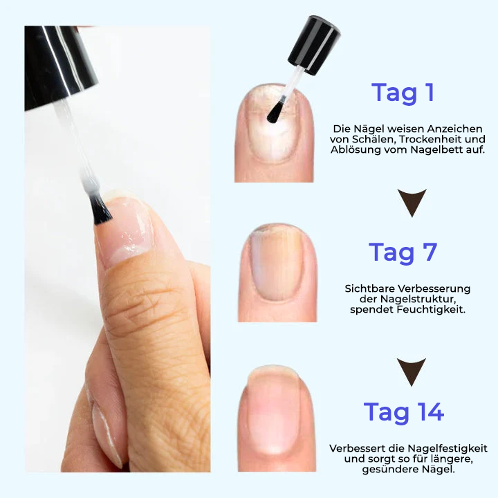 Oveallgo® OnyxoGuard Wachstum der Nägel und Reparaturserum