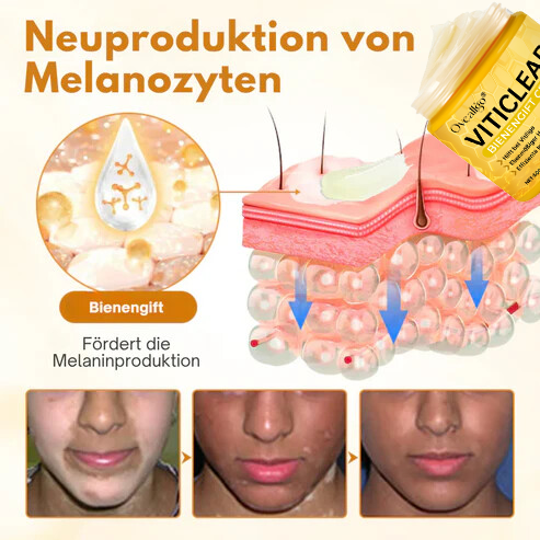 Oveallgo® VitiClear Bienengift Creme Prox