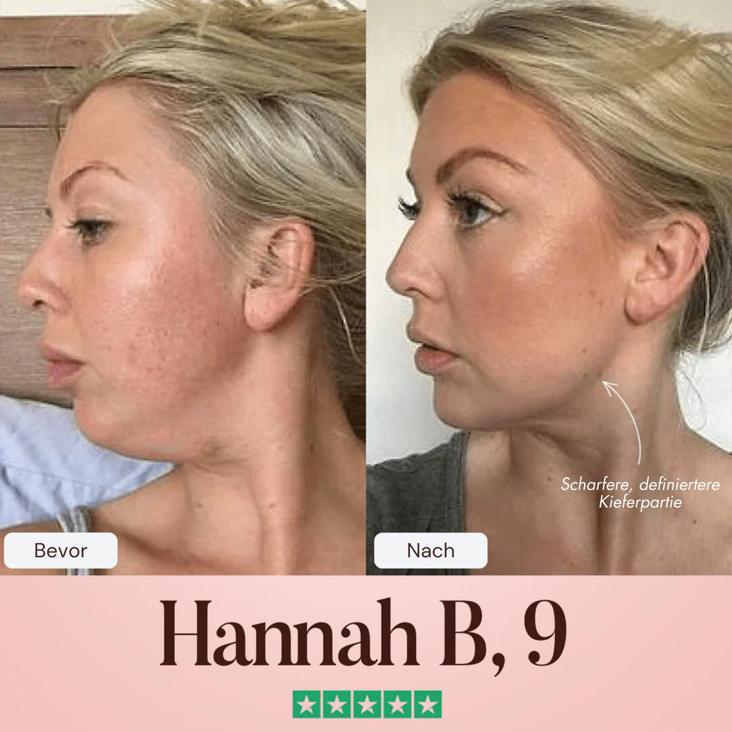 Oveallgo® SculptFix Maske Infundiert mit Retinol und Kollagen um Ihre beste Kieferpartie zu enthüllen